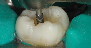 Evolving conservative dentistry