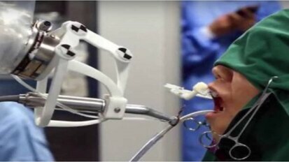 Robot independently places 3-D printed implants in a patient in China
