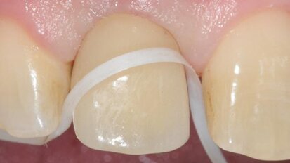 Maintenance of dental implants for the hygienist