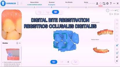 Escaneo de Registros Oclusales Digitales