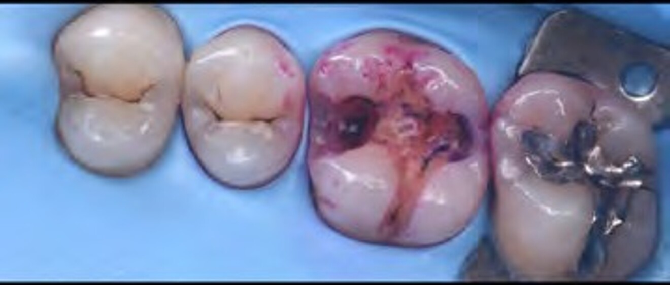  Fig. 2b: Cavity preparation completed with complete caries excavation and assessment of the remaining tooth structure. 
