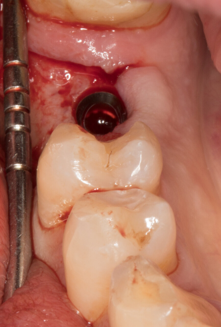 Ryc. 21 i 22_Linia łącząca 2 wypukłości zębów sąsiednich, wyznaczająca „okno estetyczne”.