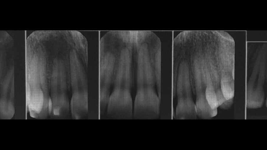 Fig. 2_Status di rx endorali. 