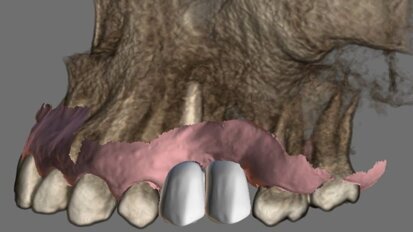 È qui il futuro: implantologia navigata con il Navident