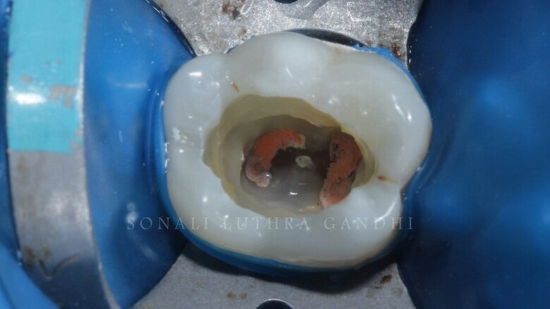 Fig 3: Removal of temporary restoration
