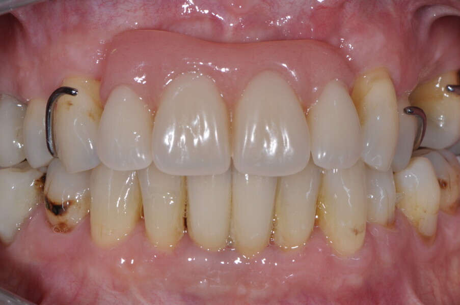 Fig. 6: Intra-oral image with the temporary prosthesis in place.