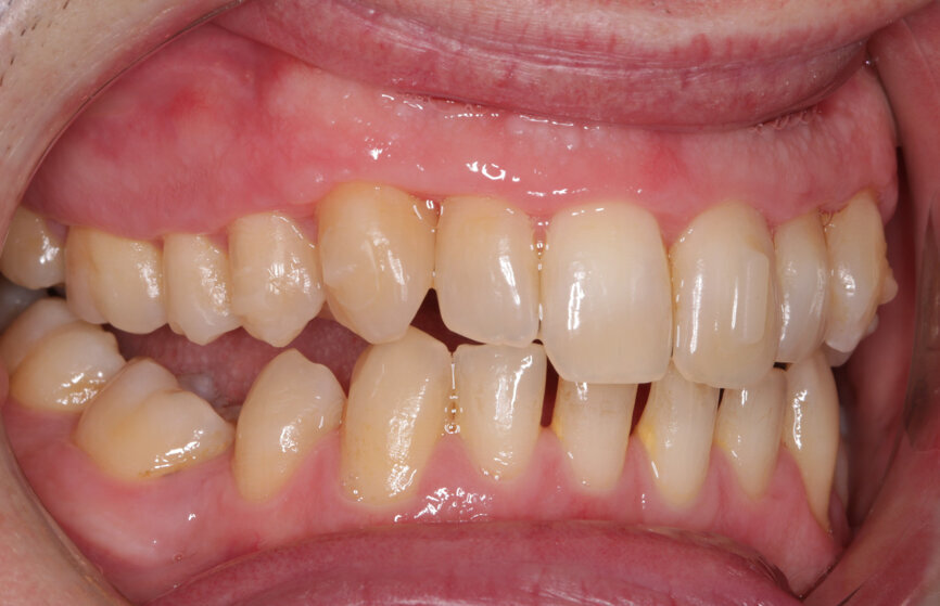 Fig. 12: Post-initial alignment, prior to refinement aligners right lateral view