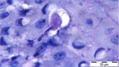 Parodontitis: Mundspezifische Amöbe entlarvt Parodontitis: Mundspezifische Amöbe entlarvt