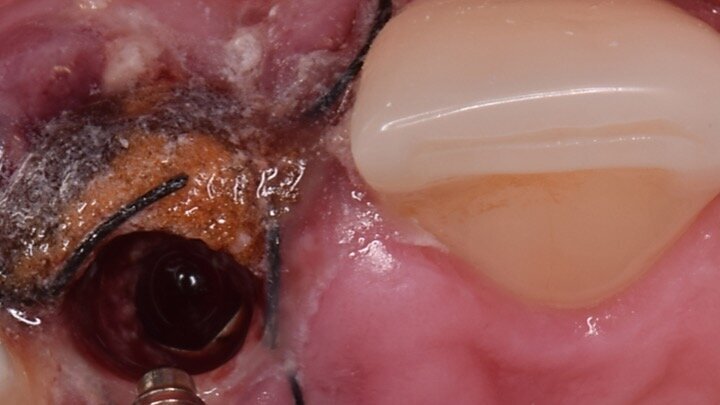 Figura 14. Durante las 24 h. siguientes a la intervención, el paciente tiene que evitar los enjuagues hasta que la prótesis provisional haya sido insertada. Al retirar el pilar de cicatrización temporal podemos observar por fuera la forma que adoptan las membranas de colágeno para cerrar el defecto, y, por dentro, la posición esférica de las partículas debido a su contacto con el pilar.