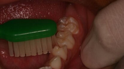 Ultra-conservative treatment (UCT)