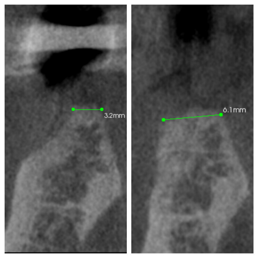 Fig. 1c_Aumento orizzontale dei tessuti duri del 50%.
