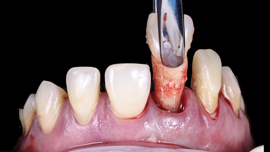 Fig. 14: Atraumatic extraction. The first step of preserving the gingival profile is by not damaging it during extraction.
