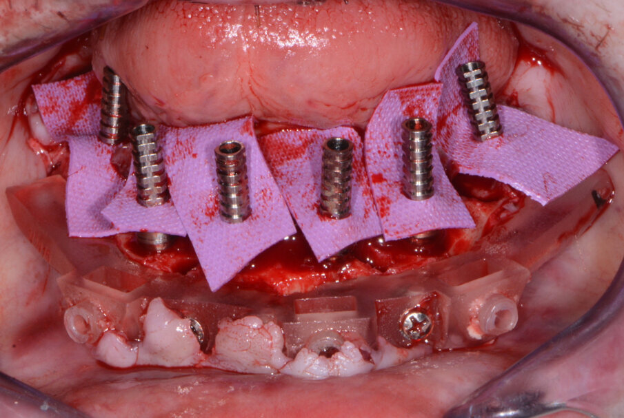 Fig. 14: Mandibular temporary cylinders isolated.