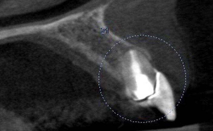 Fig. 4: Pre-op CBCT scan.