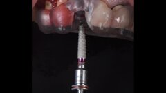 Workflow digitale nella protesizzazione immediata di un impianto abutment free