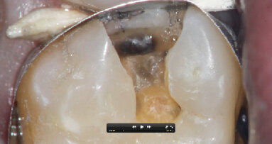 Dentální mikroskop v běžné stomatologii