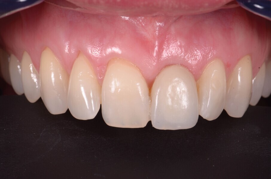 Fig. 13b : Quatre mois (b) après la pose de l’implant. 