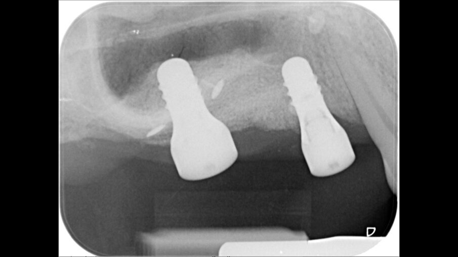 Fig. 17 - Radiografia periapicale a 6 settimane.