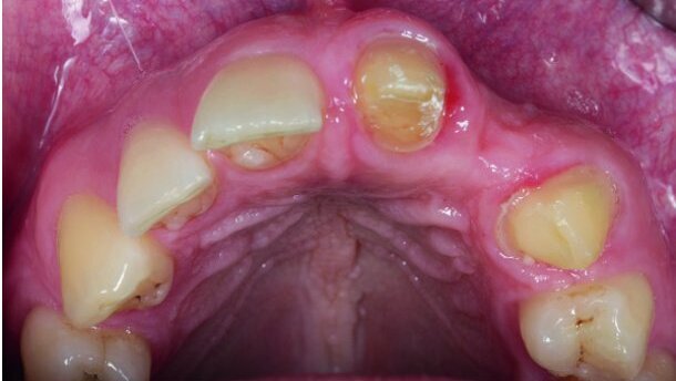 Rekonstrukcija vodoravnega defekta alveolarnega grebena s tehniko kostne lamine.