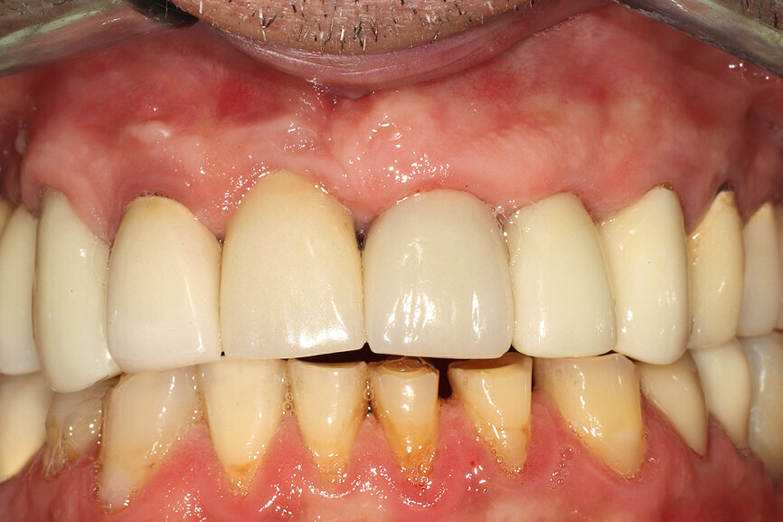 Fig. 12a: A post fracture presenting in the left central incisor, requiring extraction.