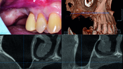 Rialzo di seno per via crestale con una pasta ossea di nuova generazione