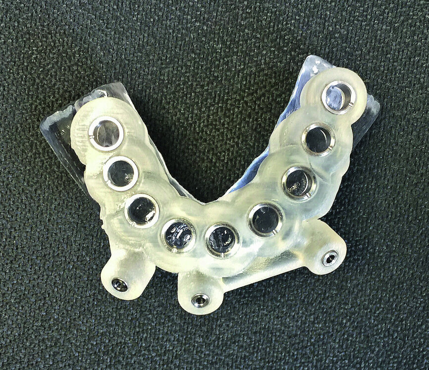 Fig. 8: Surgical guide for mandibular implants.