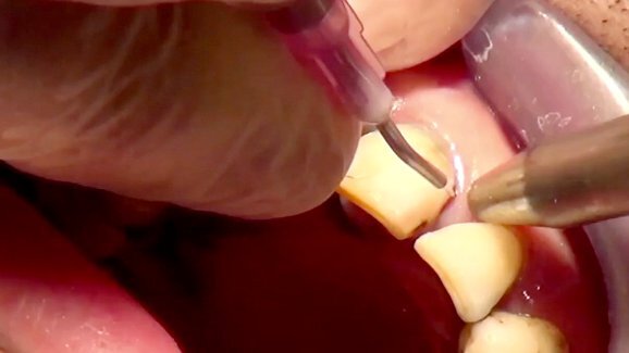 Experte erklärt photodynamische Therapiemethode