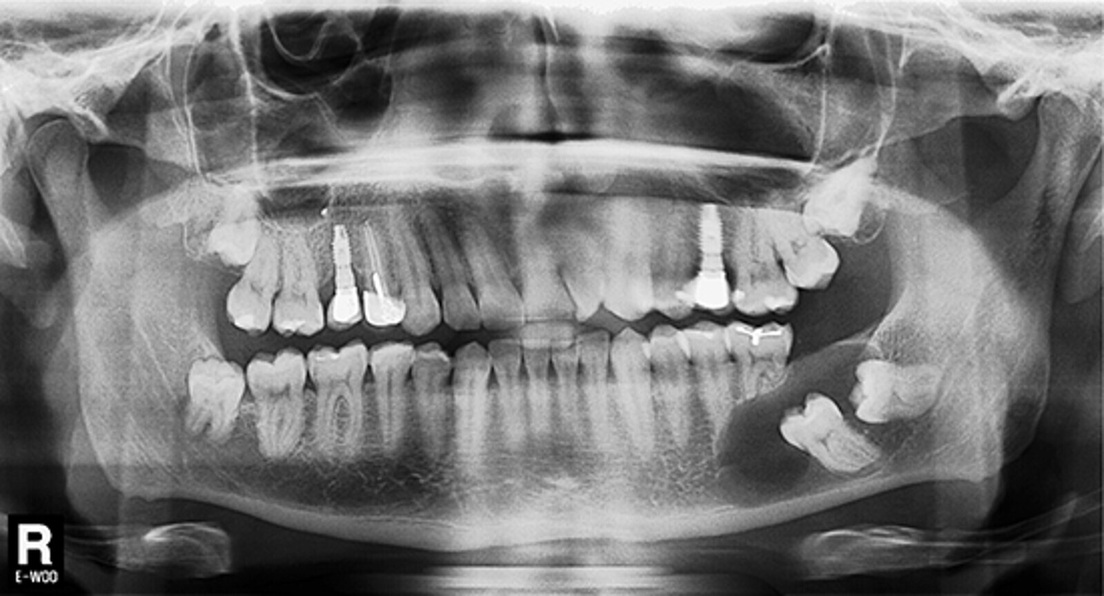 Figura 2. EvaluaciÃ³n radiolÃ³gica bidimensional. La ortopantomografÃ­a advierte la presencia de un proceso osteolÃ­tico circunscrito a las coronas de los dientes 3.6 y 3.7 no erupcionados. NÃ³tese la reabsorciÃ³n radicular de los dientes 3.5 y 3.6 debido a la extensiÃ³n del proceso osteolÃ­tico en sentido antero posterior.