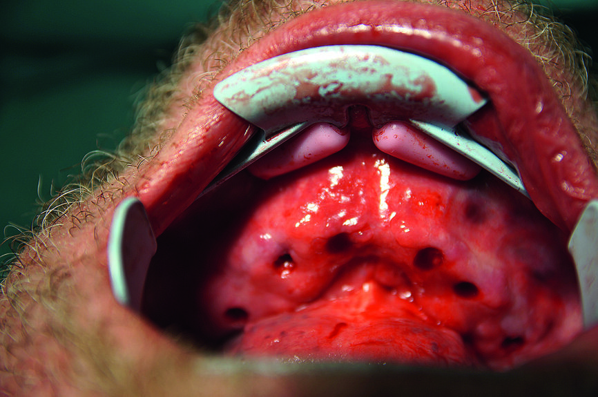 Fig. 15 : Mandibule perforée et préparée. 