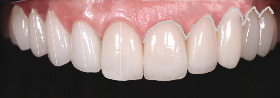 Slika 2.a Analiza zubi