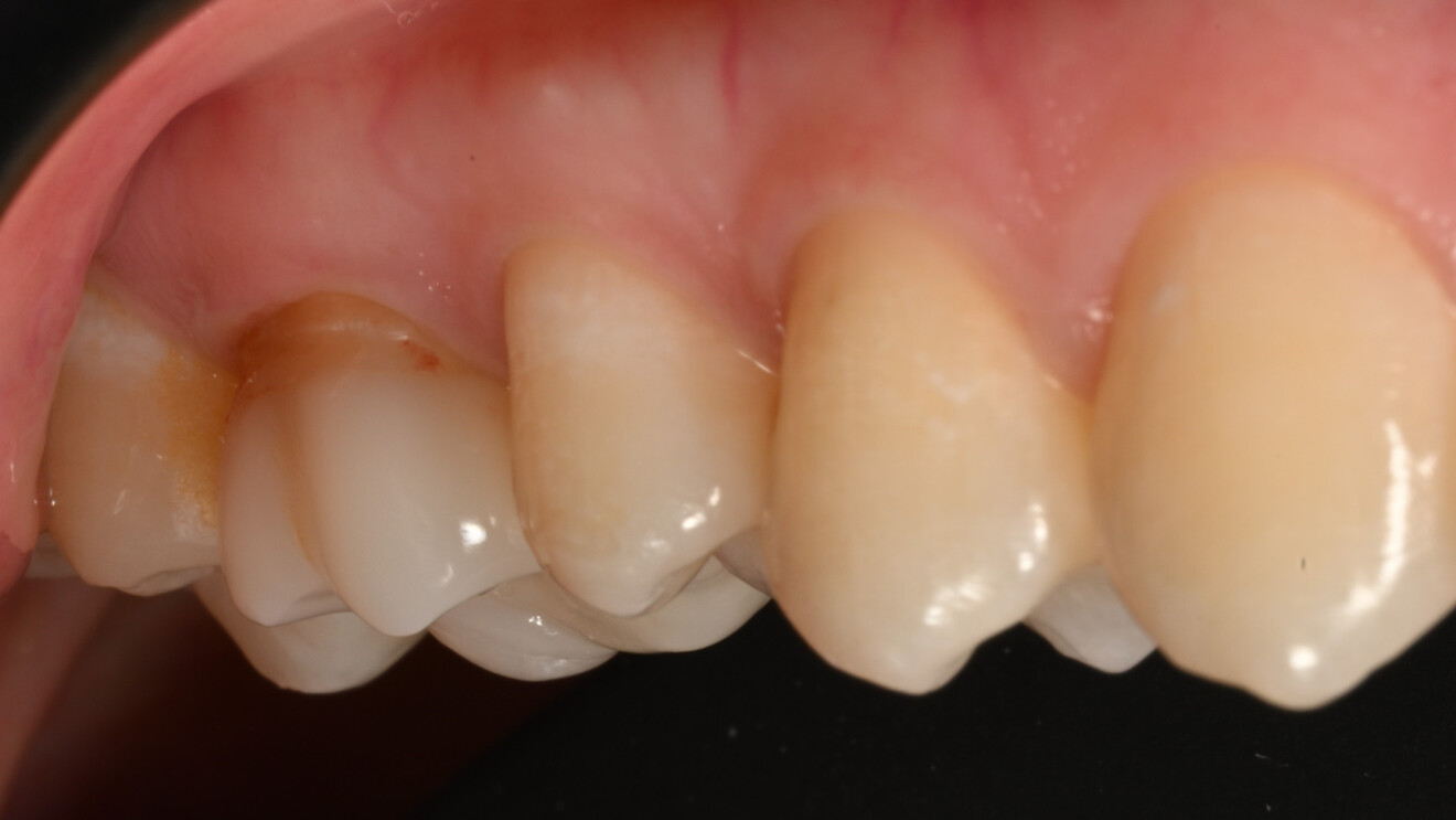 Fig. 33b: Buccal view.