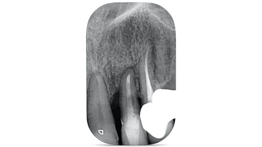 Fig. 2_Radiografia periapicale in sede 2.2.