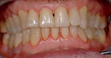 Zmiany w szkliwie – metody odbudowy