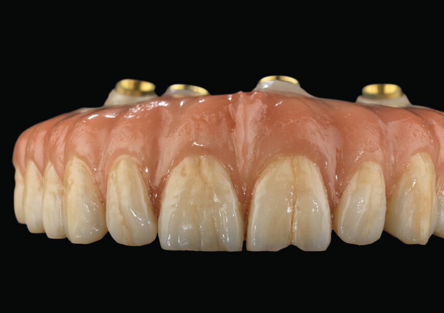 Im Jahr 2019 brachte Amann Girrbach Zolid HT+ Preshade auf den Markt. Abgebildet ist eine REAX-Brückenrestauration, 13–23 vestibulär und Gingiva-Cutback. © Luís Manuel Rocha Saraiva/Clarity Lab