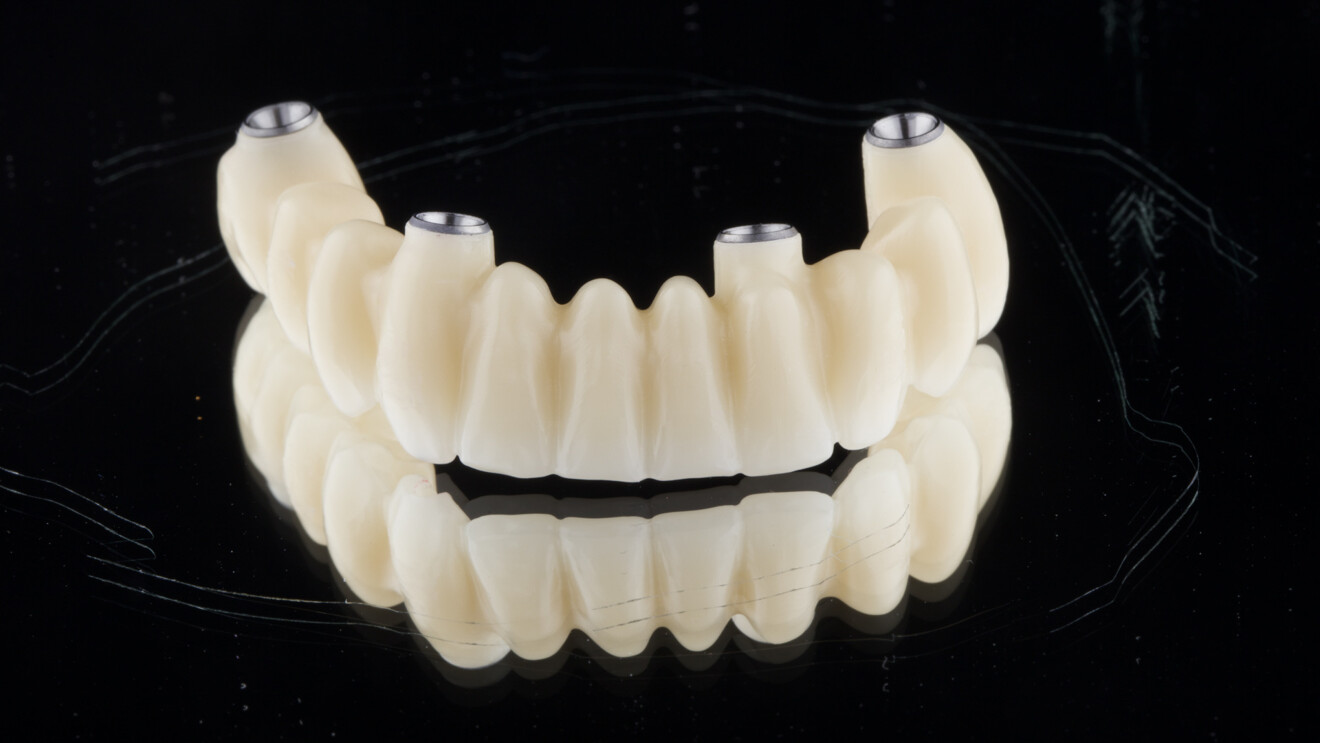 Fig. 14a: Mandibular provisional prosthesis before delivery.