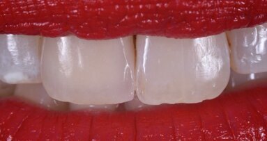 Ridge augmentation e impianto post estrattivo ritardato in un incisivo centrale