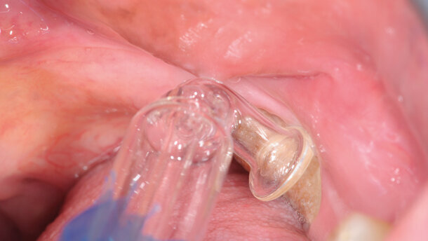 Ozonoterapia nel trattamento delle osteonecrosi mascellari