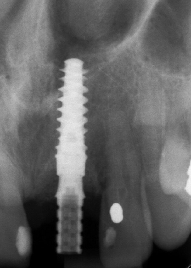 Fig. 19: Periapical radiograph to confirm temporary abutment gingival height.