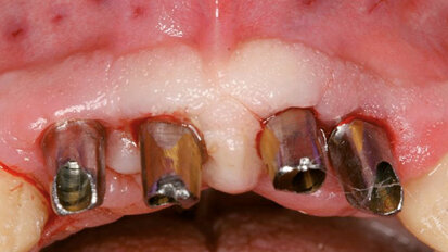 Massima estetica nel mascellare anteriore compromesso dal punto di vista parodontale: impianto immediato