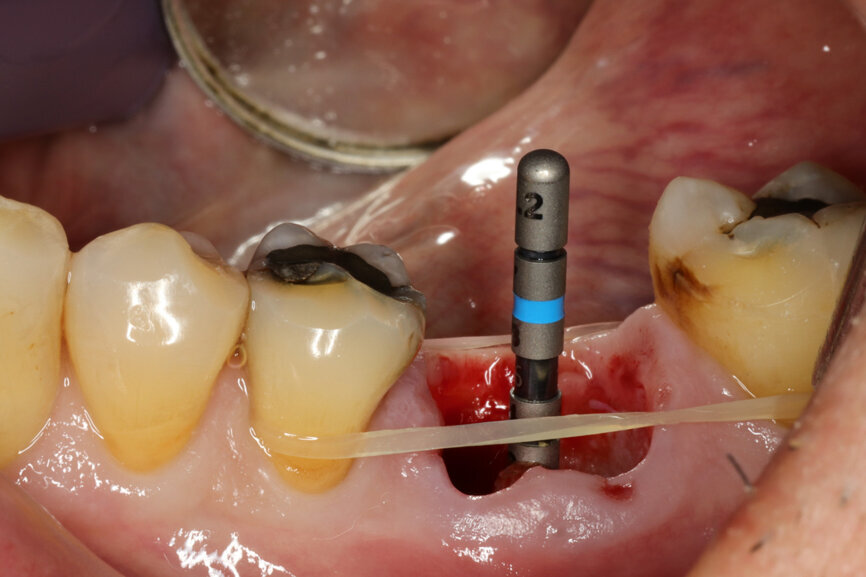 Fig. 8: Alignment of the ⌀ 2.2 mm drill, confirming 3D position.