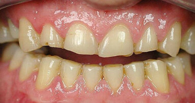 Riabilitazioni full arch con preparazioni microinvasive