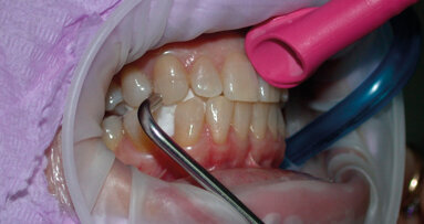 Procedura per il controllo dell’AP/EP (Air Polishing Ergonomics Procedure): tecnica, sicurezza e comfort del paziente