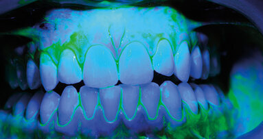 White spot: protocollo operativo di tailoring domiciliare e professionale. Case report