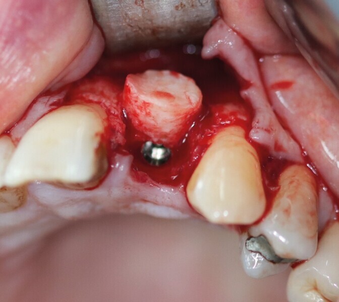 Fig. 29 : Carotte ostéo-gingivale impactée vue occlusale. 