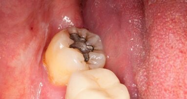 שילובים גנטיים מסוימים עשויים להיות אחראיים על רגישות לכספית