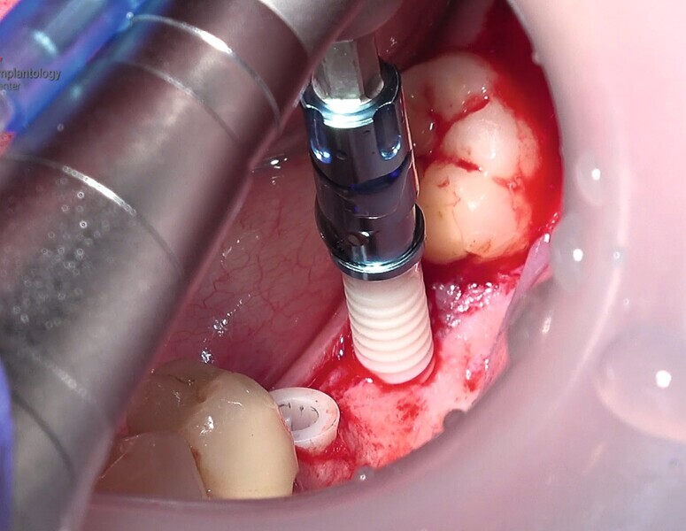Fig. 27  : Pose de l’un des implants deux pièces en céramique au niveau tissulaire. 