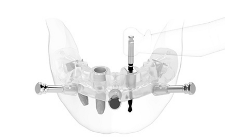 Nobel Biocare – NobelGuide