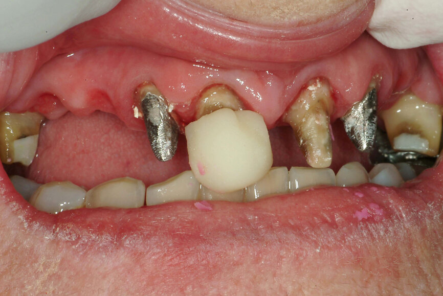 Fig. 22: Analogue recording of centric relation using a composite device to stabilise the mandible and polyvinylsiloxane recording paste.