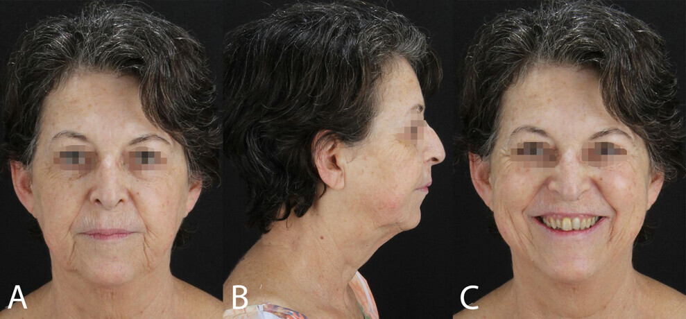 Figs. 1a–c: Orthodontic treatment planning based on extra-oral photographs. (a) Frontal view. (b) Lateral view. (c) Patient smiling.