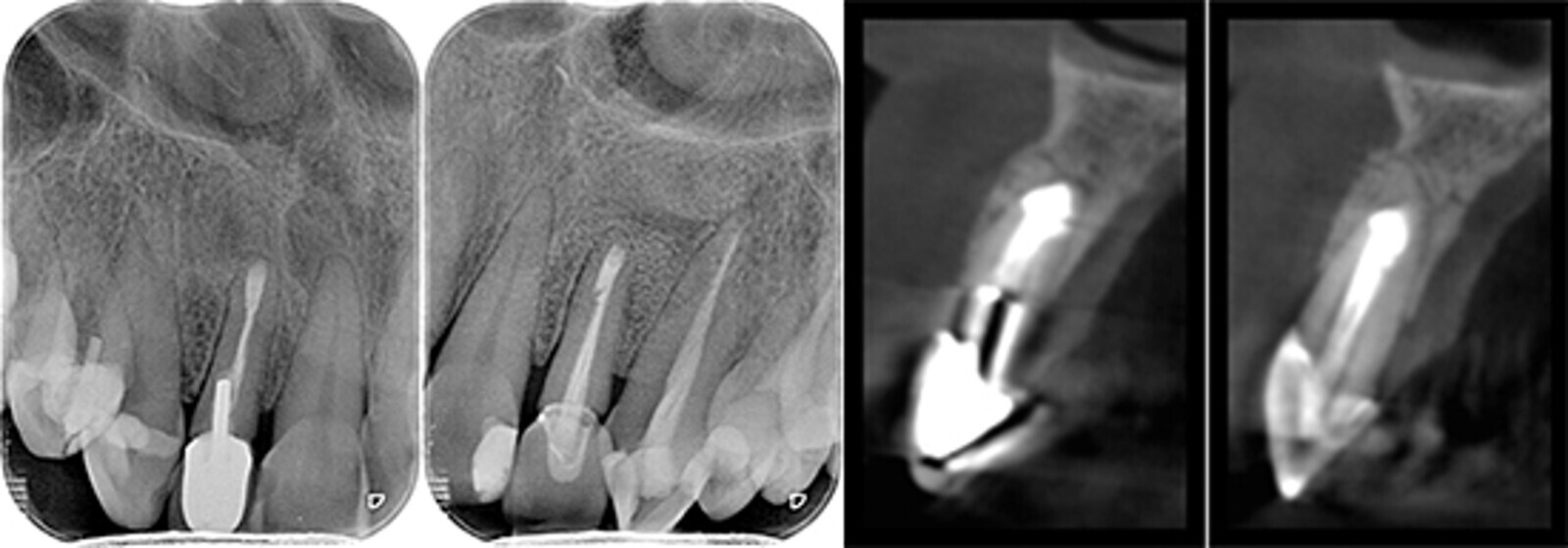 Figuras 12-16. Control clÃ­nico y radiogrÃ¡fico al aÃ±o de la cirugÃ­a periapical. Los cortes del TCHC muestran la regeneraciÃ³n completa de la cortical vestibular.